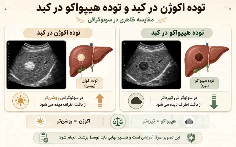 توده اکوژن و هیپواکو در کبد